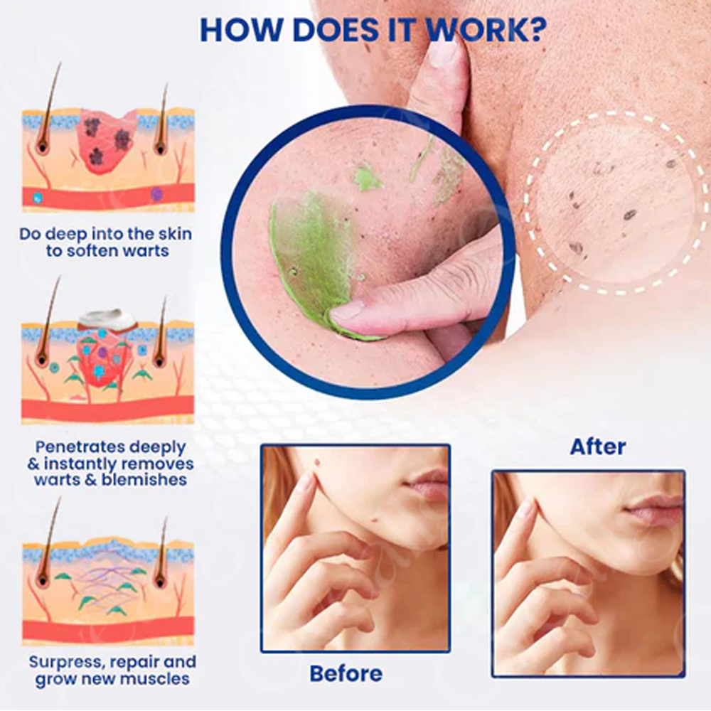 NatureErase | Gel for Spots, Moles and Warts