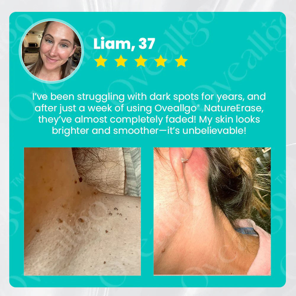 NatureErase | Gel for Spots, Moles and Warts