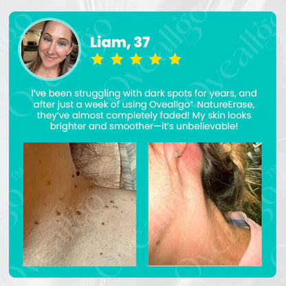 NatureErase | Gel for Spots, Moles and Warts