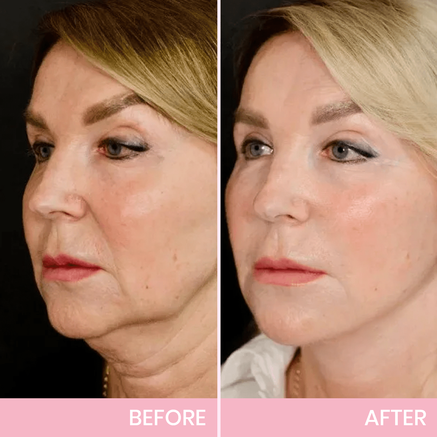InvisiLift™ | Invisible Adhesive Tape for Face Lifting