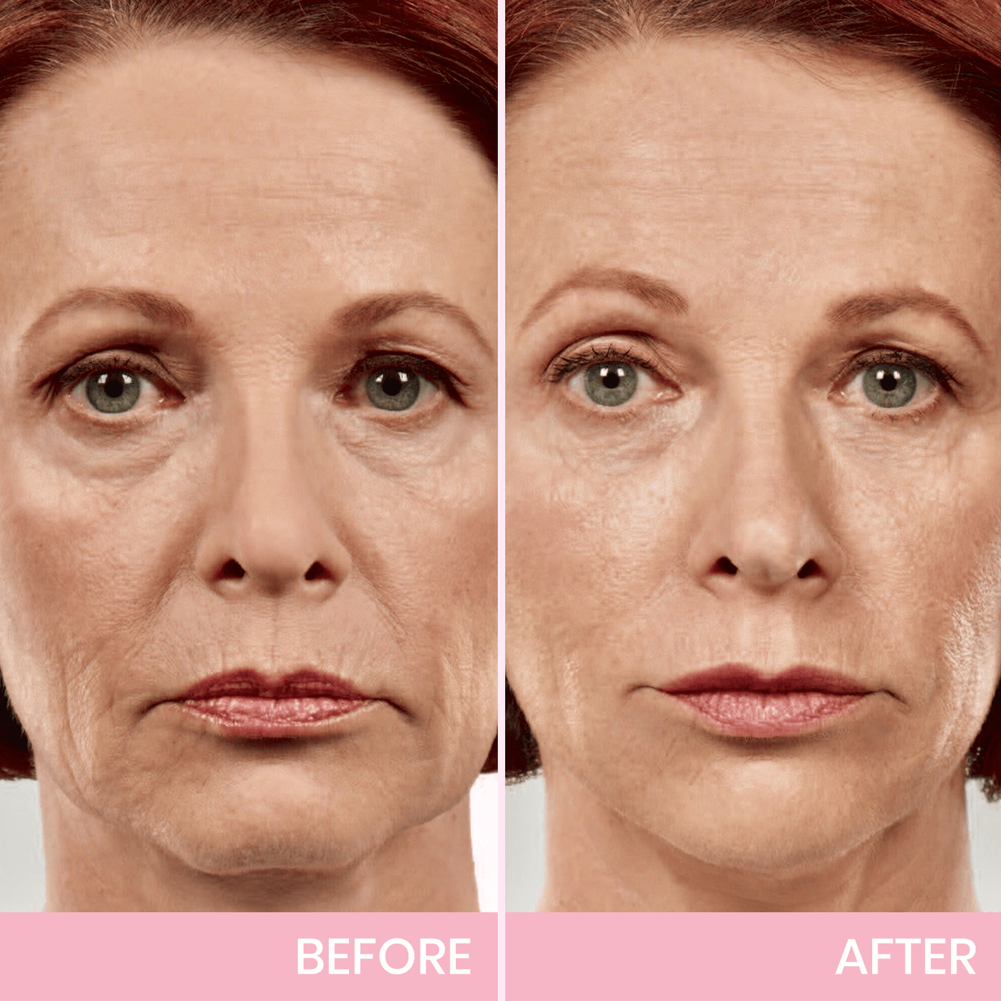 InvisiLift™ | Invisible Adhesive Tape for Face Lifting