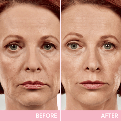 InvisiLift™ | Invisible Adhesive Tape for Face Lifting